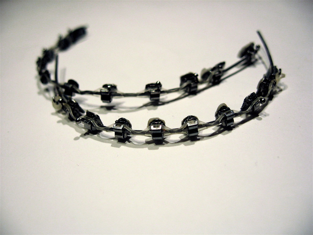 Dental_braces