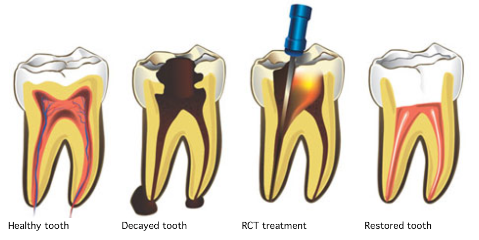 What Is Root Canal Treatment Dr Nechupadam Dental Clinic 