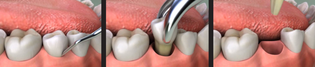 tooth-extraction