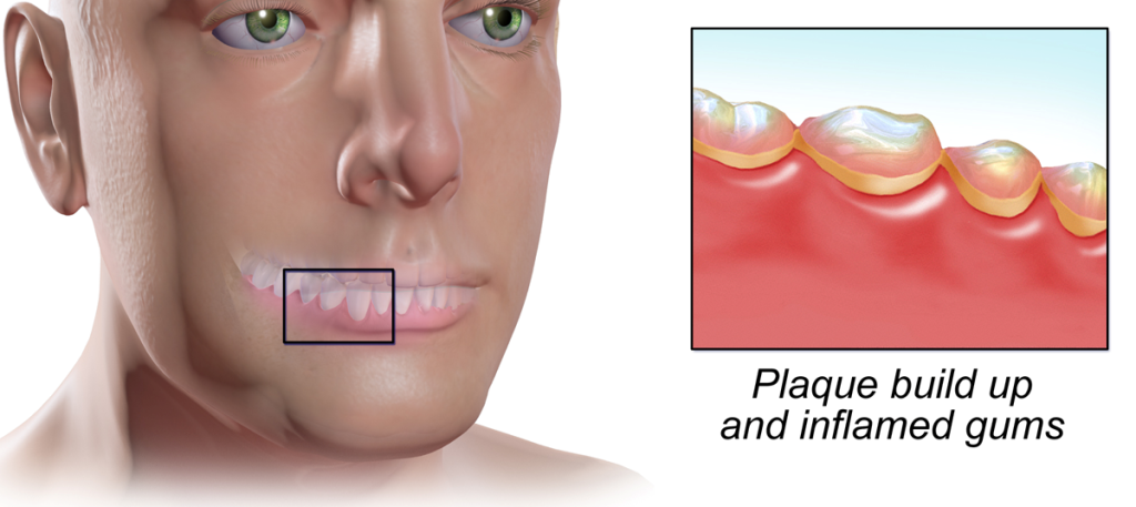 Do you know how Gingivitis and Gum Disease Develop