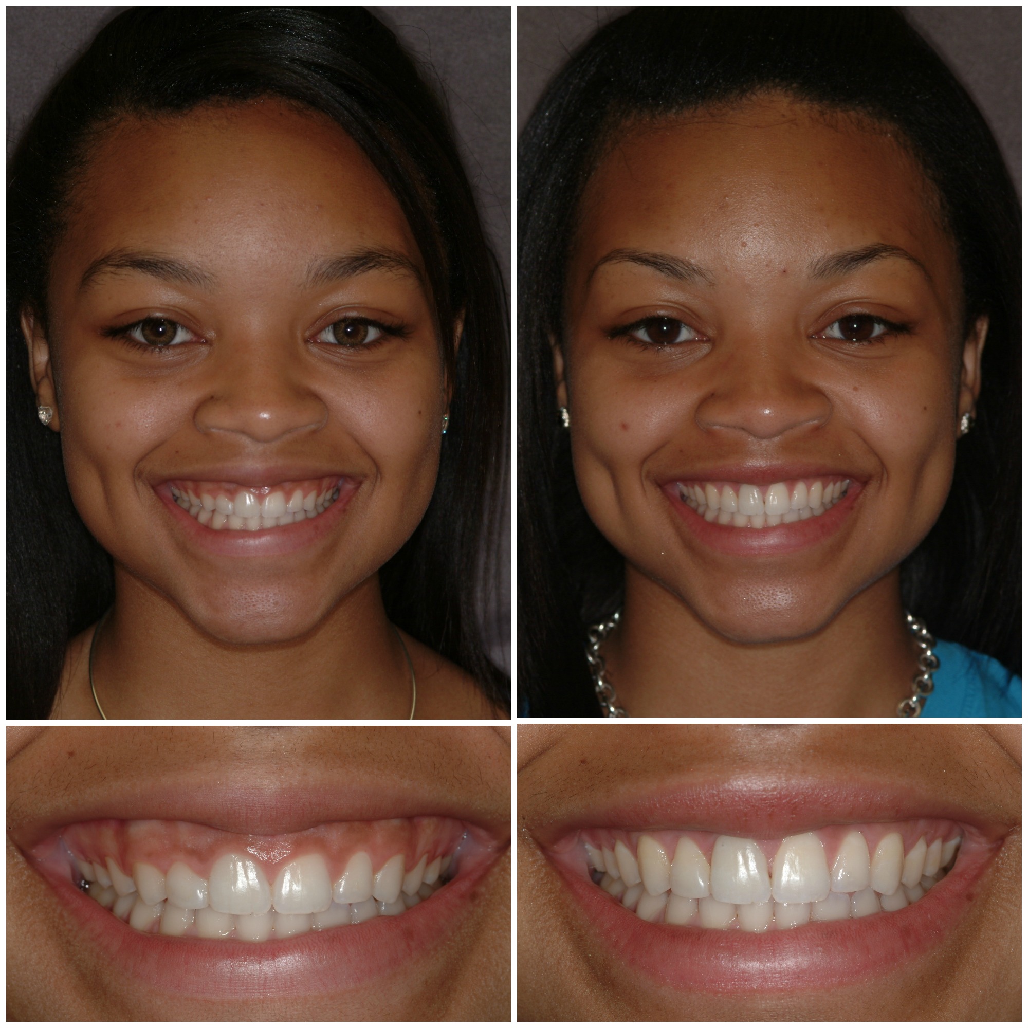 Косметического контурирования зубов