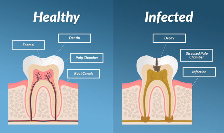 restoring-the-tooth-after-root-canal-dr-nechupadam-dental-clinic