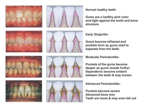 What are gingivitis and gum disease? | Dr. Nechupadam Dental Clinic