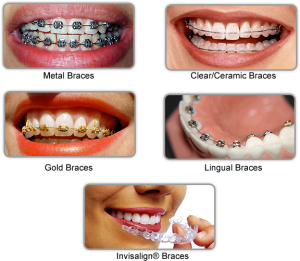 Are you feeling anxious about getting braces? | Dr. Nechupadam Dental ...