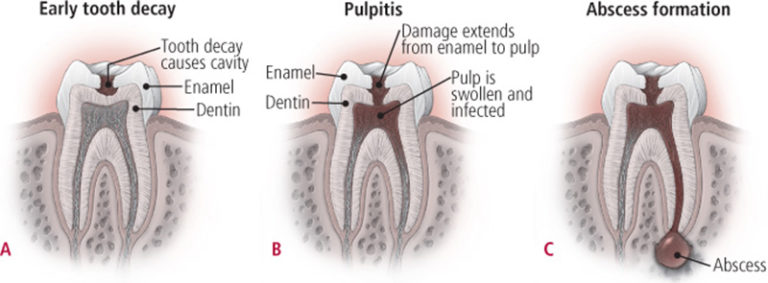 Cavities and Tooth Decay | Dr. Nechupadam Dental Clinic