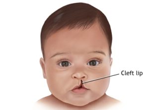 Cleft Lip And Cleft Palate | Dr. Nechupadam Dental Clinic