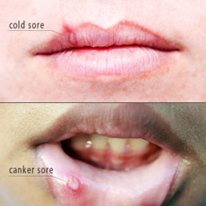 Canker sore and Cold Sores are same?? | Dr. Nechupadam Dental Clinic