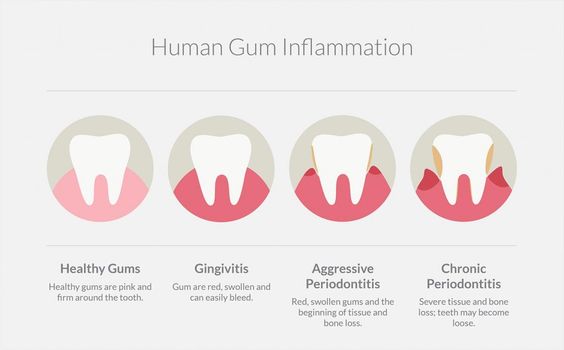 Gum disease and health complications | Dr. Nechupadam Dental Clinic